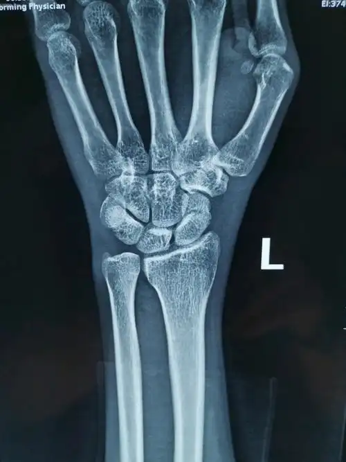 图片发自160医生app13左腕舟骨骨折13图片发自160医生app13皮肤