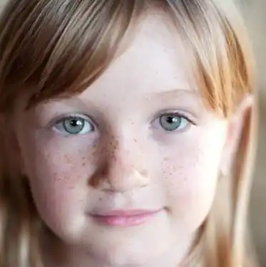 不想做"斑"长,小小的孩子怎么也会长雀斑?