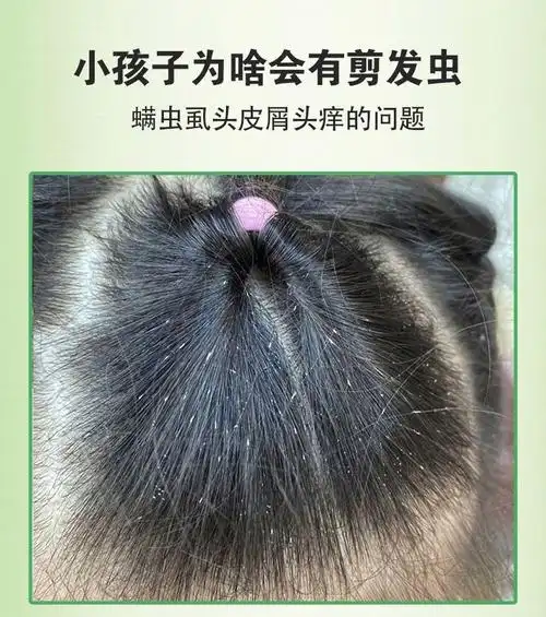 洗发水儿童止痒去剪发虫儿童洗发水除螨头发虱子去头屑止痒植物洗发液