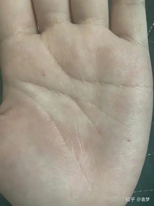 手心突然长了个小黑点是怎么回事?