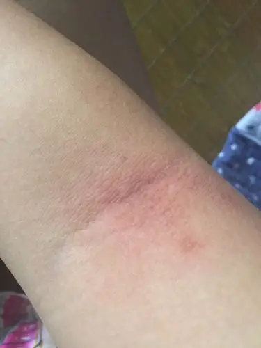 双侧胳膊肘部内侧昨天突然就变这样了也没受伤也没挠一弯