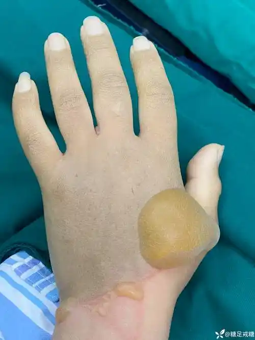 这种烫伤你见过吗? - 丁香园论坛