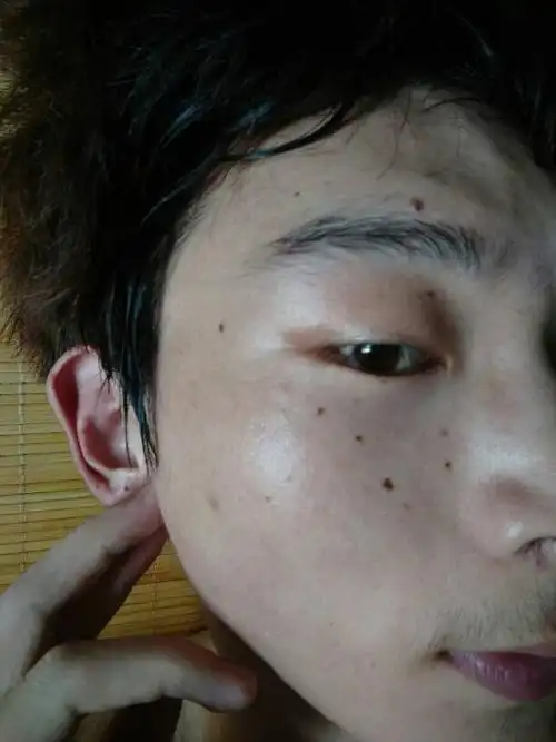 为什么脸上的黑点越来越多,以前耳朵上没有的啊,这些是雀斑吗,怎么
