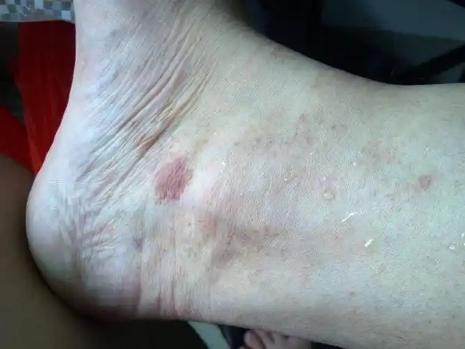 脚面上长红色斑块