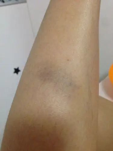 小时候没事,现在25岁,腿磕一下就会紫好久,甚至2周才能下去,以前轻轻