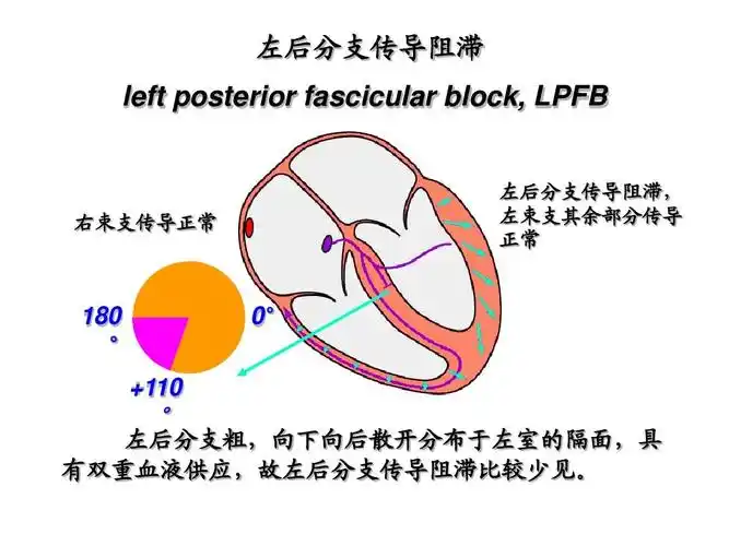 艺术 my常规心电图简介2ppt 常规心电图,心电现象 左后分支传导阻滞