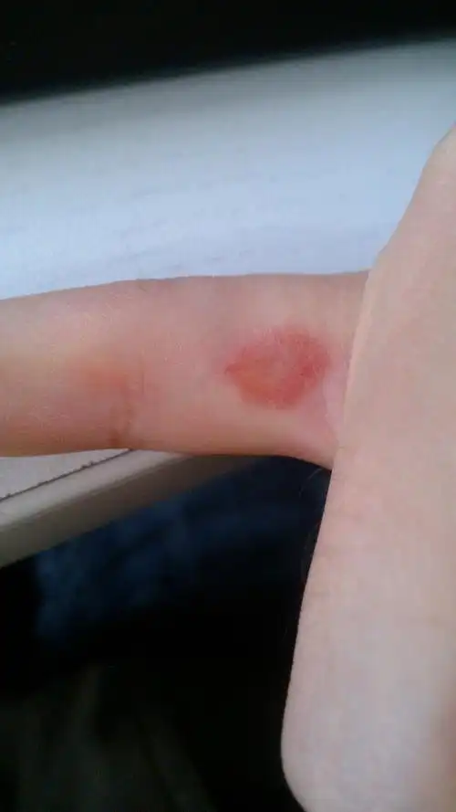 手指长了一个红斑 越来越大 像是毛细血管破裂··没有不适感觉