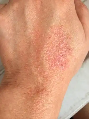 我手背上的小疙瘩,夏天有,痒些,皮肤变粗糙,好像出点油些,这是怎么