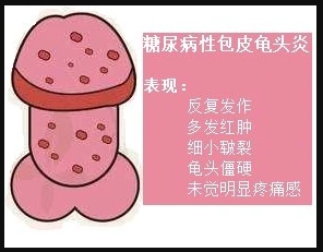包皮龟头炎_介绍_发病原因_治疗方式_症状表现 - 好大夫在线