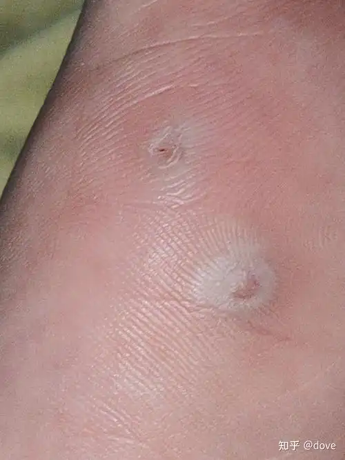 个人跖疣治疗记录已治愈