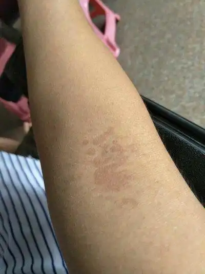 身上汗斑怎么治疗?