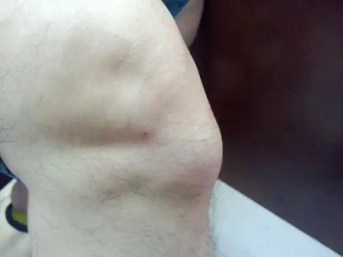 胫骨结节骨骺炎的病因