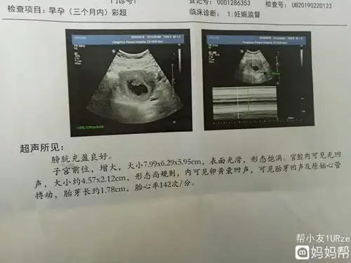 4,1孕囊大小看男孩女孩 有传言说,如果孕囊大小的长和宽的相差在一倍