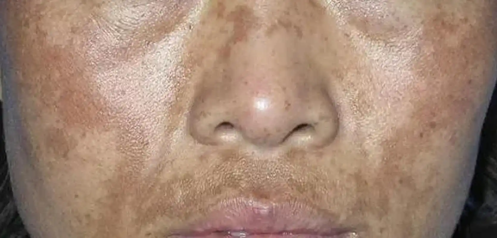 二三十岁的女性脸上长黄褐斑,很多人呢,都毫不犹豫的去打激光,但不久