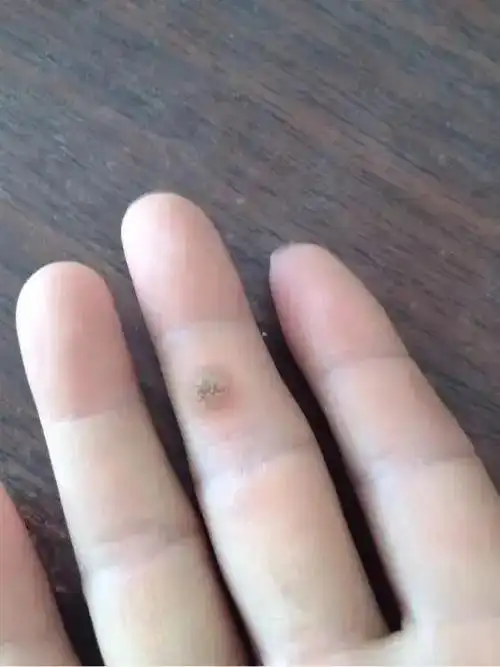 今日分享: 疣是由人乳头病毒(hpv)感染引起,表现为皮肤表 - 抖音