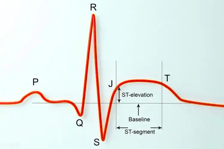 心梗来"敲门",心电图出现2个异常,基本一查一个准,早知早好