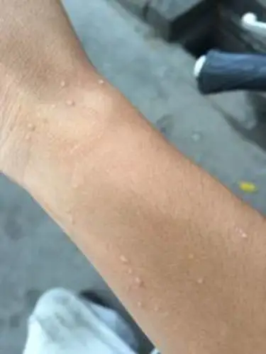 胳膊轻微扁平疣图片