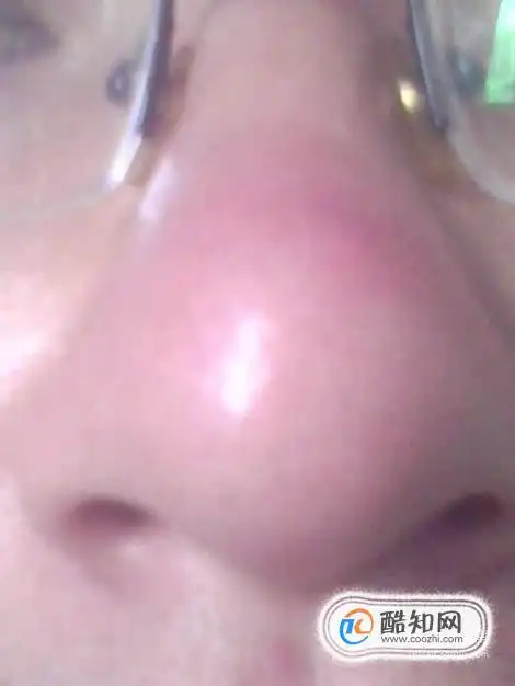 鼻头红肿疼痛怎么回事优质