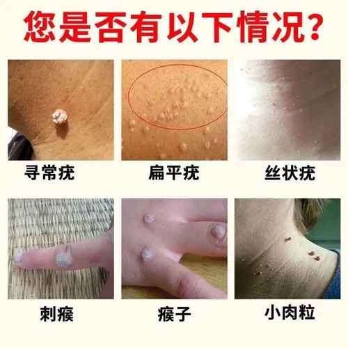 药店直售 专攻去疣去除脖子小肉粒赘皮扁平尤祛疣瘊丝状尤腋下小猴子