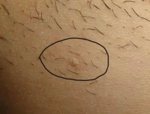 如果感染了hpv,在患病初期阶段,女性的私处会出现一些淡红色丘疹,这些