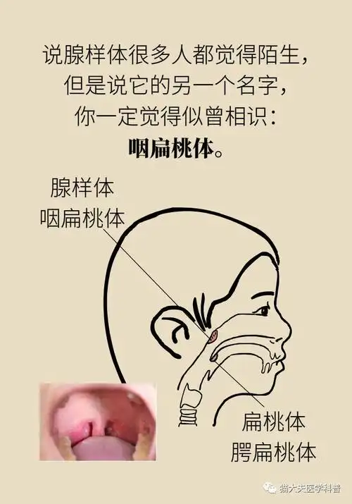 小孩腺样体肥大一定要手术切除吗