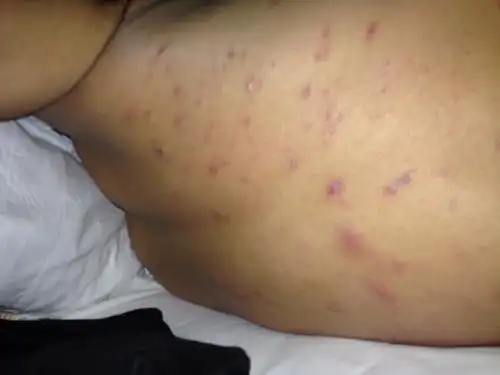 后背有很多小红点儿,有点儿像青春痘那种,感觉好可怕.这是什么病?