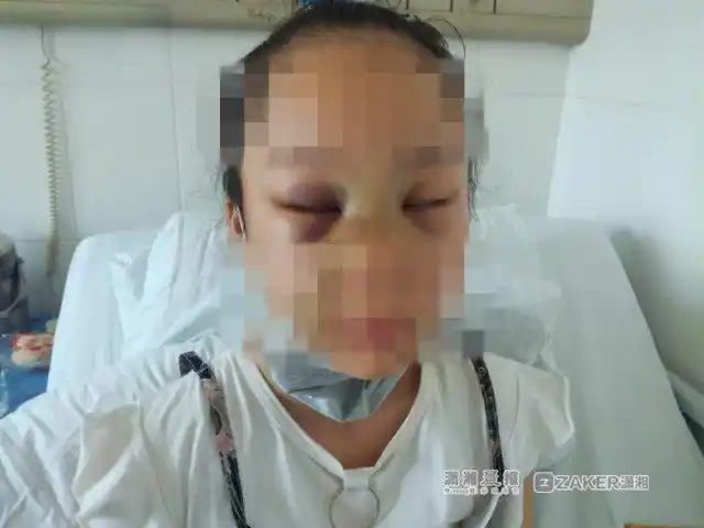 玩单杠时不慎摔伤,13岁女孩田甜(化名)鼻骨骨折.