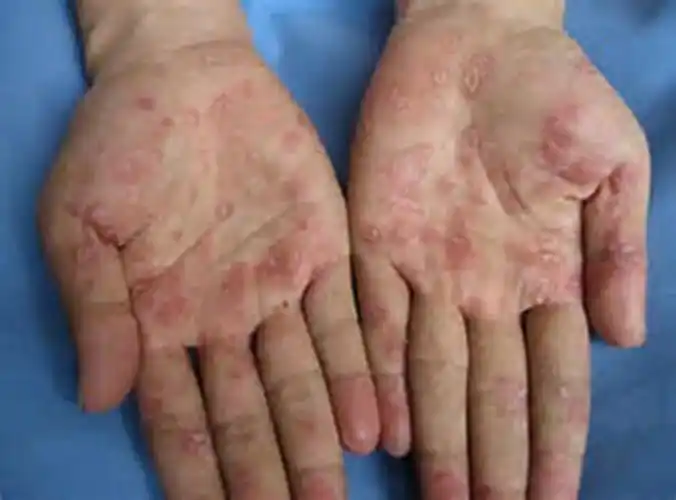 梅毒淋病口腔症状图片