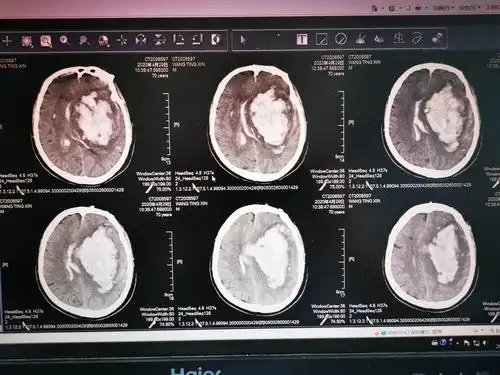 术前头颅ct,出血量约170ml