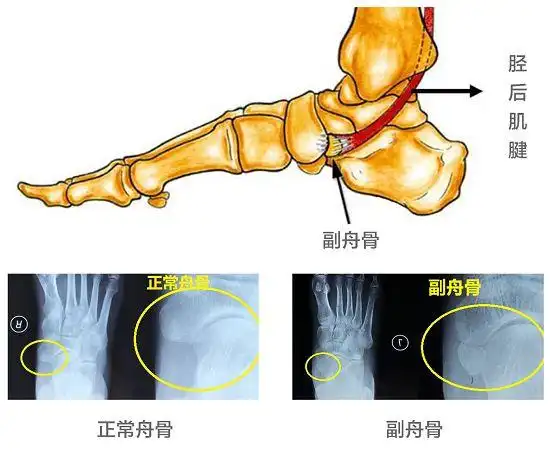 10的人可能会有一种足部疼痛副舟骨疼痛