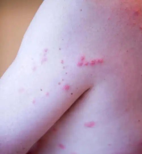 跳蚤咬过后的疙瘩照片 跳蚤怎么彻底消灭-cosg百科