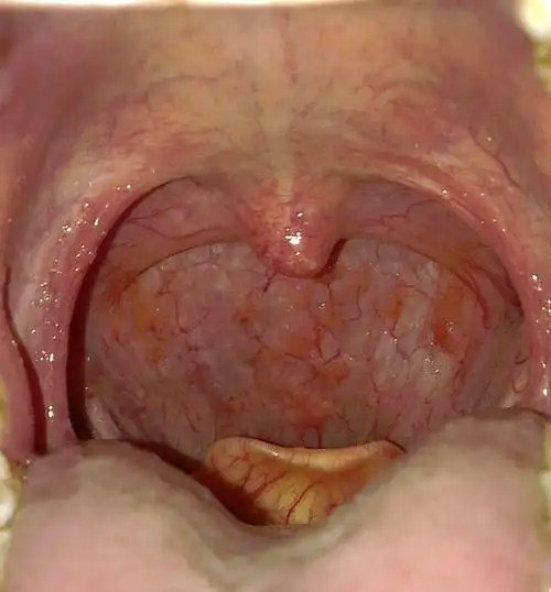 舌头根后面有个 类似小舌头的东西.