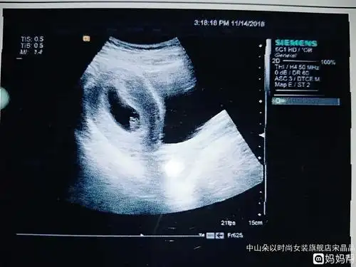 害怕!18.9*9.3孕囊能看出男女吗"福如东海"-第1张图片-酷虎博客