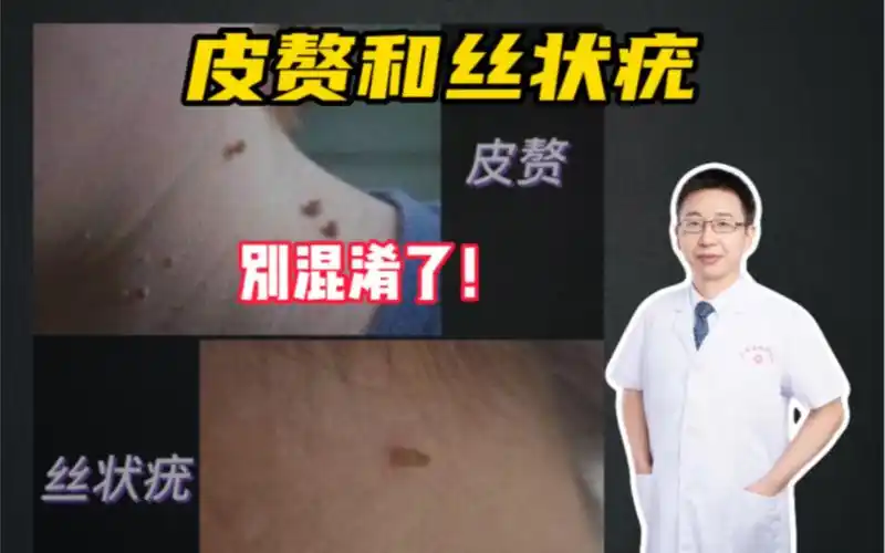 怎么区分皮赘和丝状疣?丝状疣是hpv病毒感染引起的,具有传染性!