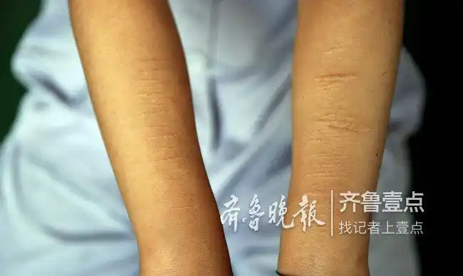触目惊心她26岁却已吸毒史5年身上疤痕累累