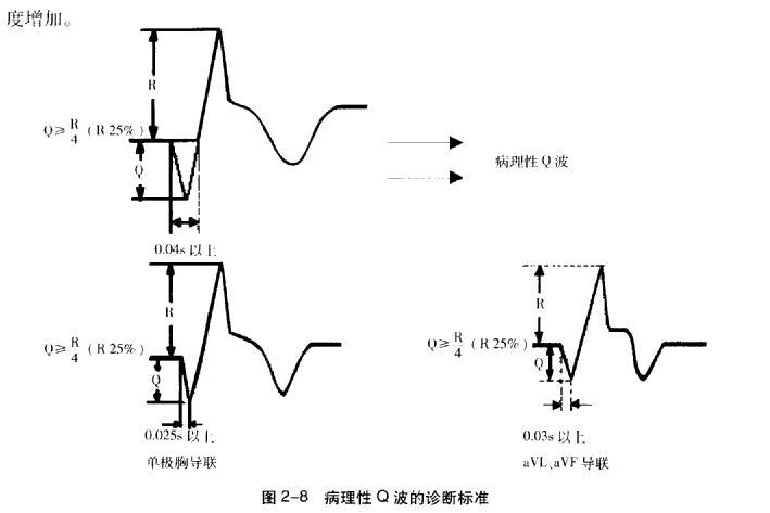什么是病理性q波呢? 病理性