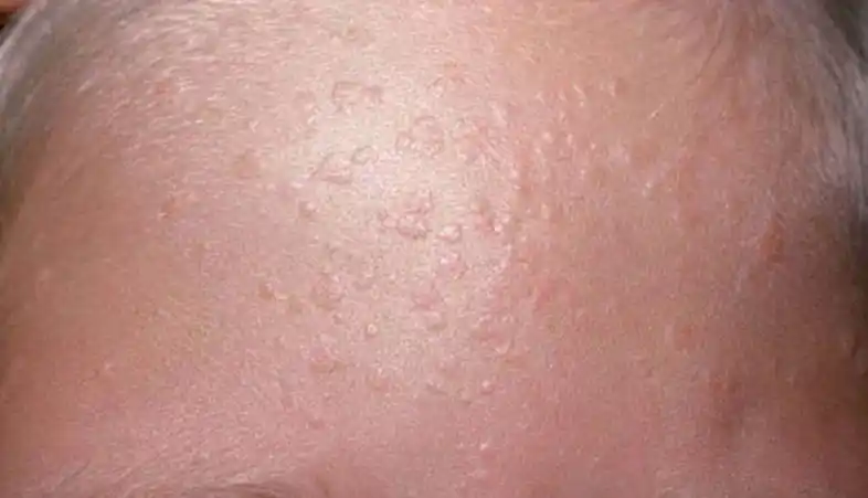 根据表现形式及发病部位不同,可分为寻常疣,跖疣和扁平疣.