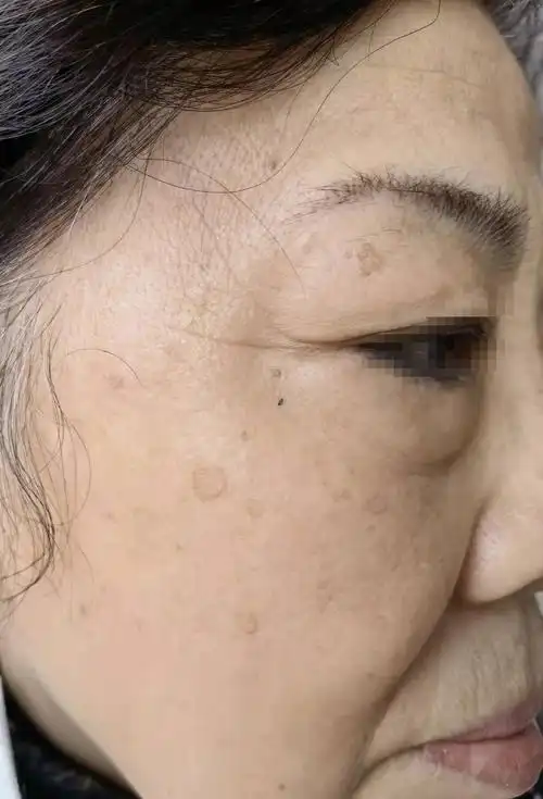 脸上的黑圈圈是老年斑