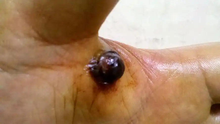 手上长了个肉瘤该怎么办?