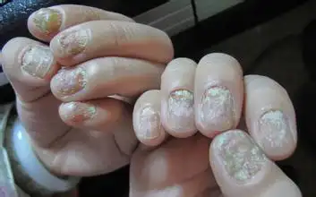 我的家人手上有灰指甲洗菜做饭这样卫生吗.吃下的