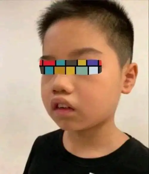 "腺样体面容"怎么预防和处理?