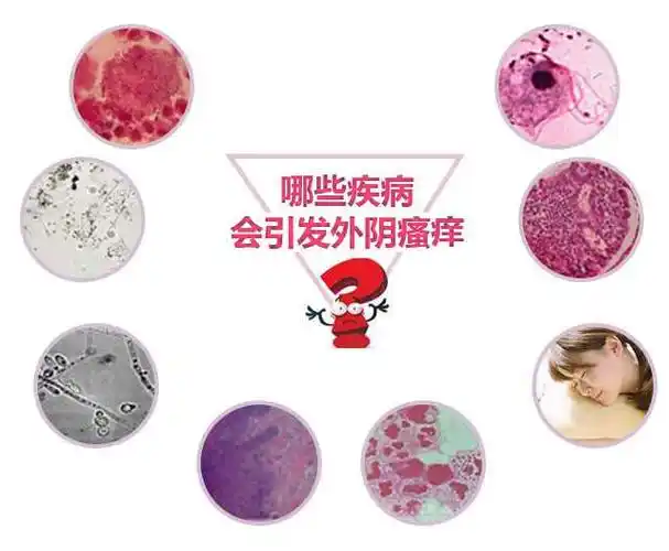 淋病外阴白斑霉菌性阴道炎细菌性阴道炎临床数据证实10个外阴瘙痒女性