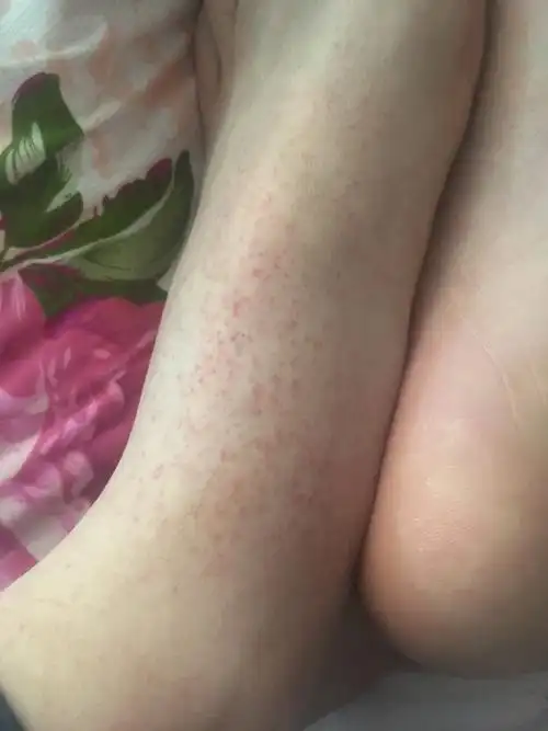 的红点一到冬天就出现夏天就没了(这个状况持续有三四年了)病情描述