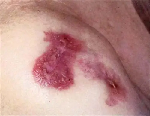 性病图片_性病症状表现图片大全_有来医生