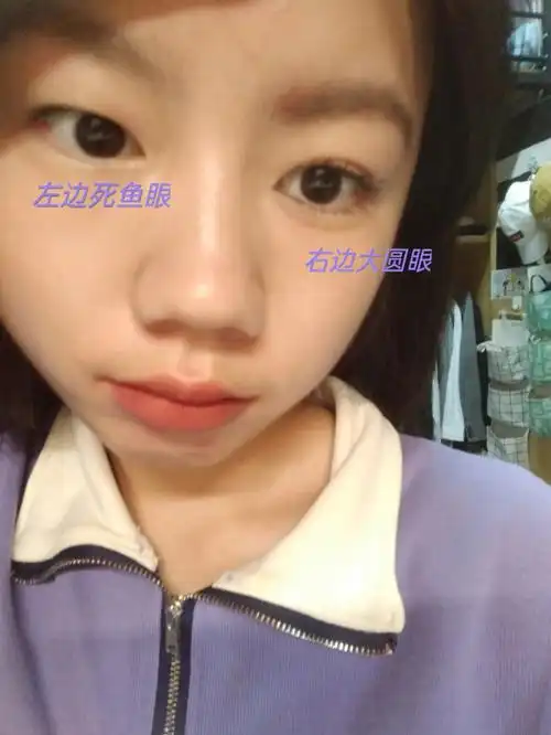 死鱼眼如何变大圆眼02