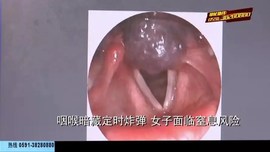 漳州一女子咽喉暗藏定时炸弹随时面临窒息风险竟全然不知