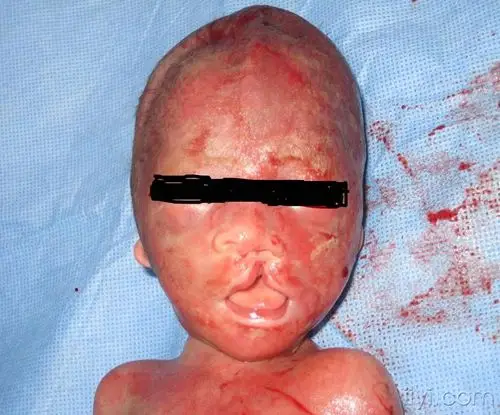 典型ii度唇裂图像