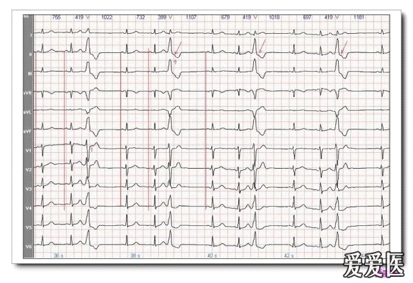 (十六)室性心律失常