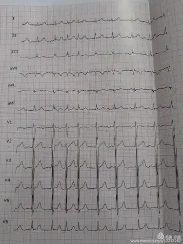 异常心电图图谱