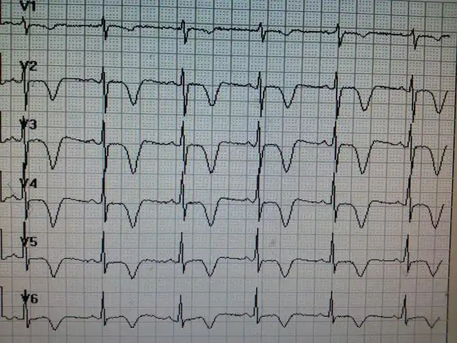 冠状t一例 - 心电图脑电图专业讨论版 - 爱爱医医学论坛
